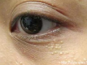 黑眼圈有几种表现类型，如何去除黑眼圈？