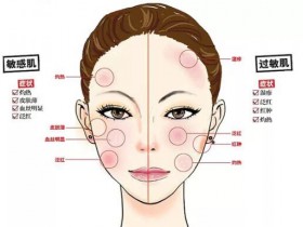 激素脸（过敏性皮炎）症状得四个阶段是什么？如何修复激素脸？